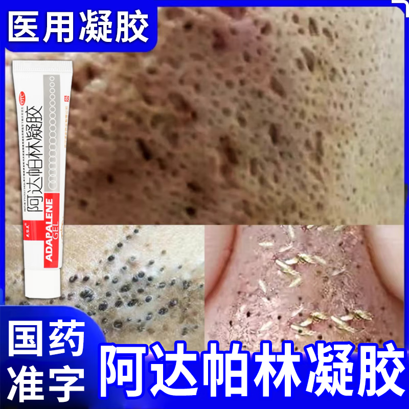 阿达帕林用十天了没有效果_用阿达帕林一个月没反应_用阿帕达林几天有效果