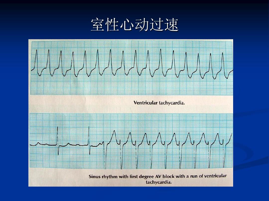 阵发性室上性心动过扑的可怕经历：心跳加速、头晕目眩，如何应对