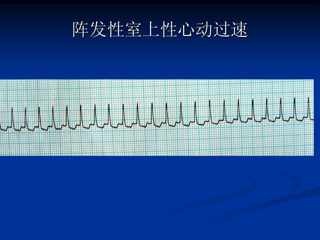 阵发性室上性心动过扑_阵发性心房扑动的治疗_阵发心房扑动