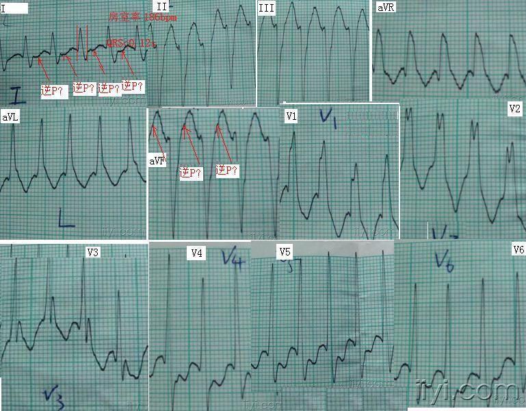 阵发性室上性心动过扑_阵发性心房扑动的治疗_阵发心房扑动
