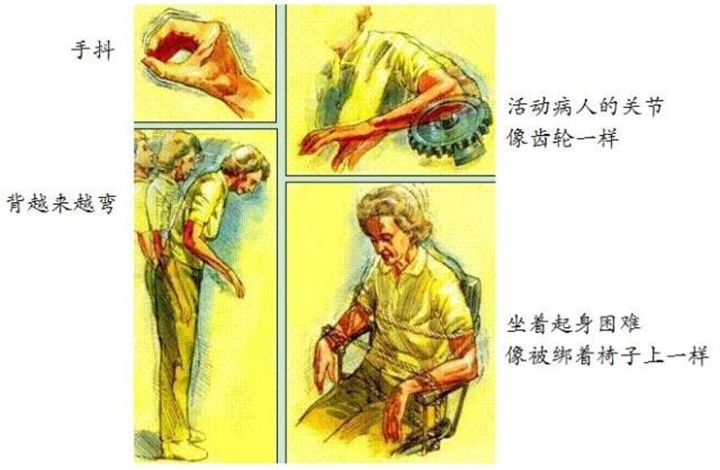 帕金森的病理机制_帕金森病理机制动画_帕金森综合症病理机制